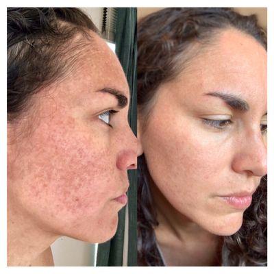 Results of 2 Nano Skin Refining facials and daily use of proper at home skincare regimen