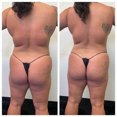 50 minutes full body sculpting and butt vacuum therapy. As you can see her back bloating went down and her butt is more plump.