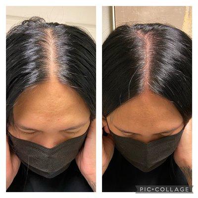 Density fill for thinning hair