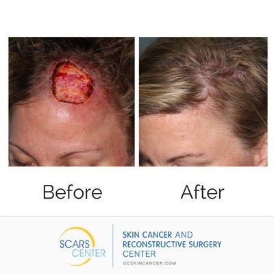 Skin Cancer Treatment and Reconstruction of Head.