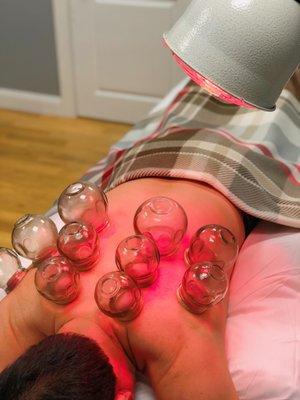 Fire Cupping Treatment