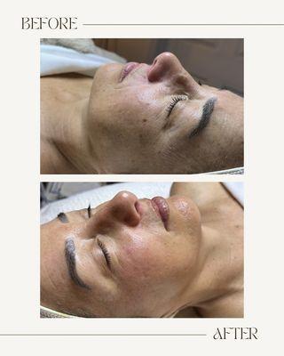 Hydro Facial instant results