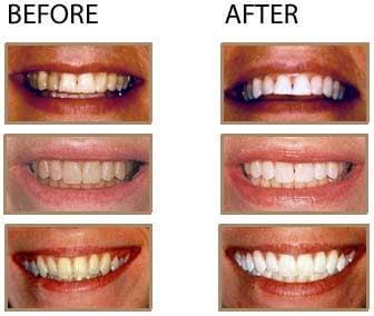 Enjoy our Zoom teeth Whitening and cosmetic Dentistry.