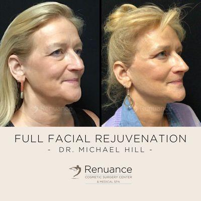 Before and after full facial rejuvenation