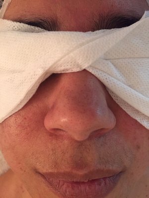 Facial client who needed exfoliation and extractions