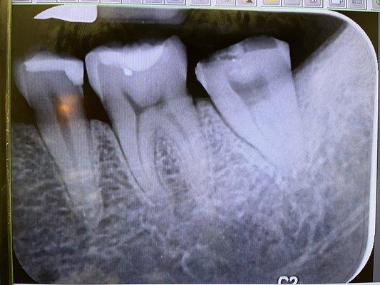 Getting the roots on my broken tooth checked out