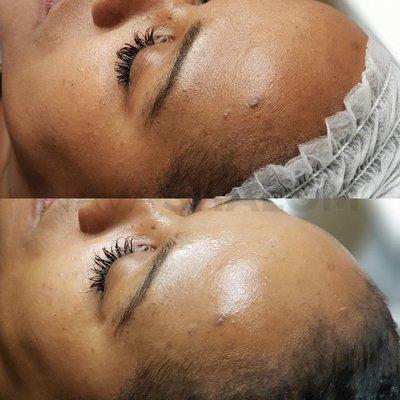 Improved tone, texture, and hydration following a Signature Facial.