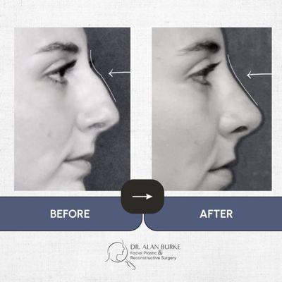 Dr. Burke's Rhinoplasty