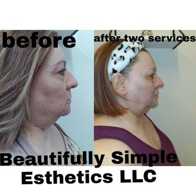 This is a before and after two services of my ultrasound facial targeting sagging skin and wrinkles.