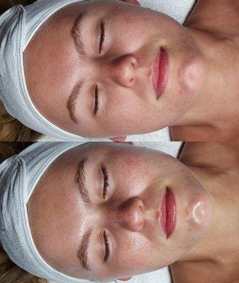 Our Clear Skin Facials provide a deep cleanse helping to heal current breakouts and prevent new ones from forming.