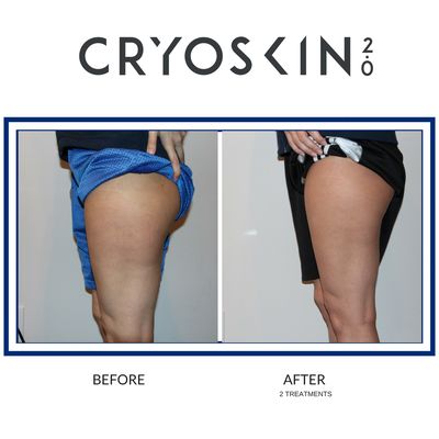 CryoToning- Female before and after