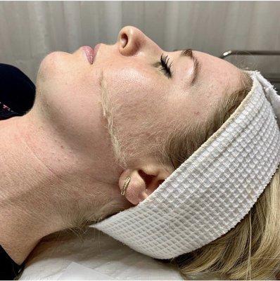 Dermaplane