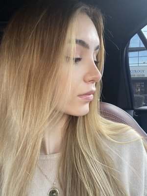 Three weeks post-op septoplasty and rhinoplasty