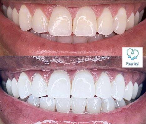 Low intensity Whitening with a 20 minute session. Instant Results and Pain Free.