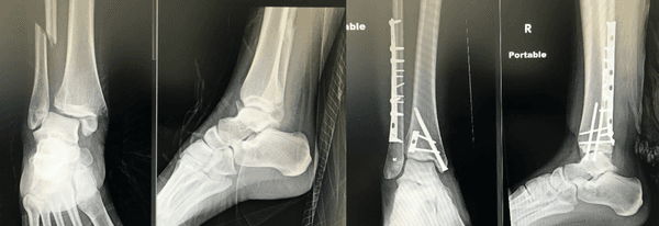 Complex ankle fracture/dislocation  before and after surgical fixation with restoration of anatomy