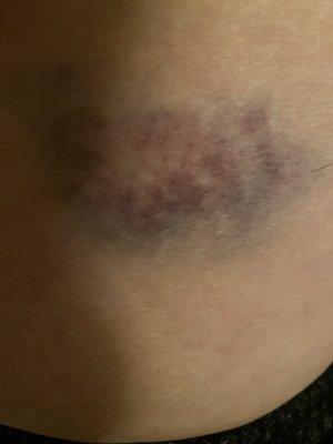 The  bruise the metal bar left