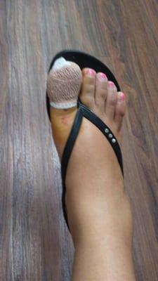 Finally the ingrown toe nail is out.