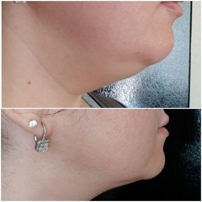 Lipo dissolve injections help get rid of unwanted chin fat