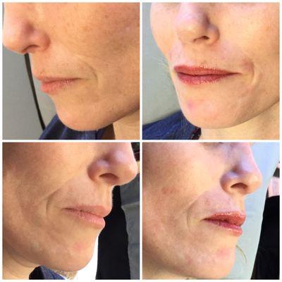 Lip enhancement, symmetry & color.