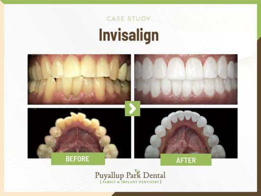 Puyallup Park Dental Family Emergency Implants Braces Invisalign | 13909 Meridian E suite a-1, Puyallup, WA 98373 | Call: (253) 435-0333