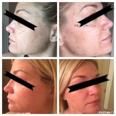 Lightening of pigmentation from acne with a Lira Clinical chemical peel