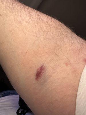 Bruised arm from blood draw