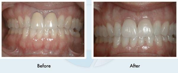 Crowns - nice and natural, before and after