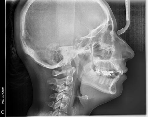 Lateral Cephalometric X-ray