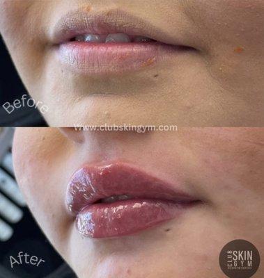 Pillow Lip Package