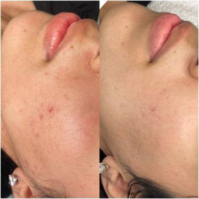 Microneedling