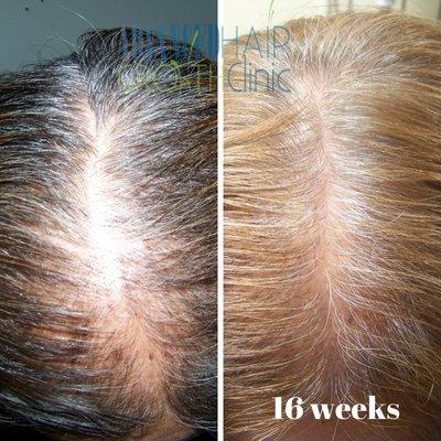 Thinning hair / Excessive shedding - Treatment program available