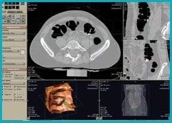 Virtual Colonoscopy