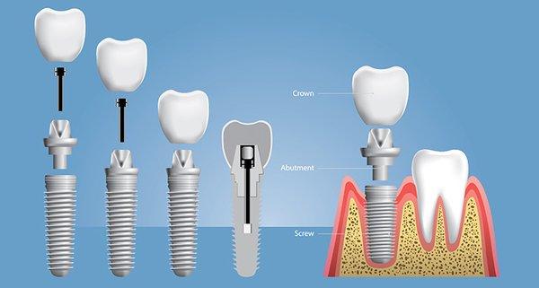 Dental Implant