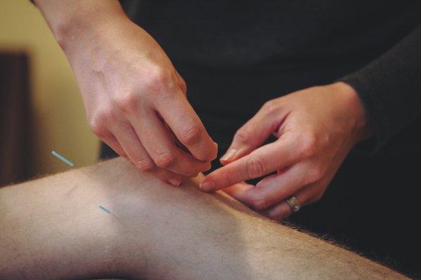 Gentle, effective acupuncture treatment