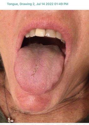 After treatment for Hairy Black Tongue