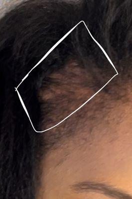 The beginning of traction alopecia. The right side of my head. My hair is pulling because of tight braids.