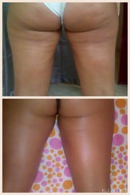 Cellulite reduction