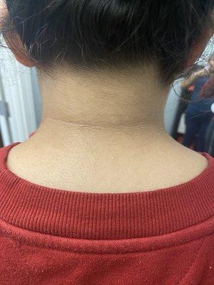 Back of the Neck; Skin Lightening Treatment 
Before and after