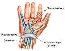 Carpal tunnel pain may be reversed.