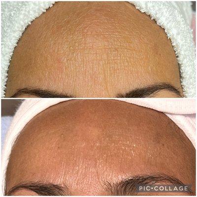 Before and after 1 treatment of Microneedling. Serve dehydration on the forehead. After one session with hyaluronic acid.