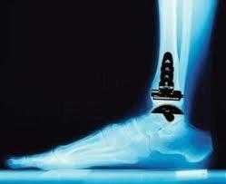 Total Ankle Replacement X-Ray