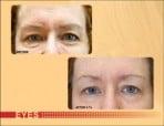 Skin Rejuvenation with Exilis!