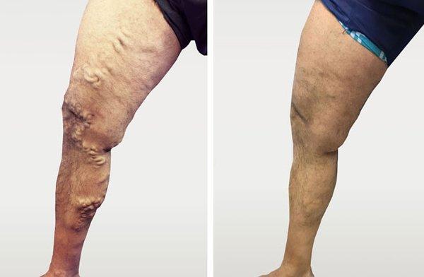 Varicose veins before and after phlebectomy