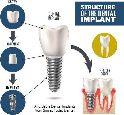 Dentist in Rancho Cucamonga.
Dental Implants consultations available. 
909.944.2800