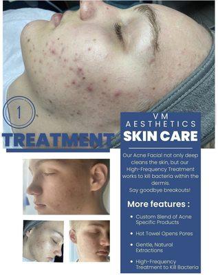 Acne Treatment!