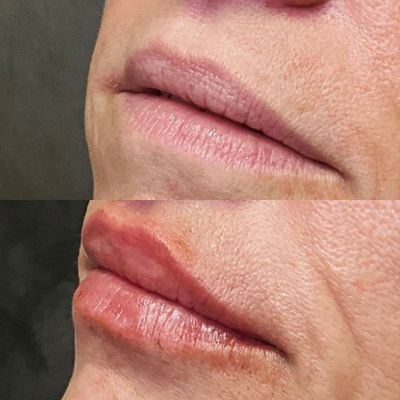 Lip Filler Transformation