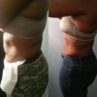 Non-Invasive Lipo (Cavitations) Results!