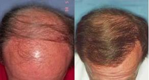 Chattanooga Hair Restoration