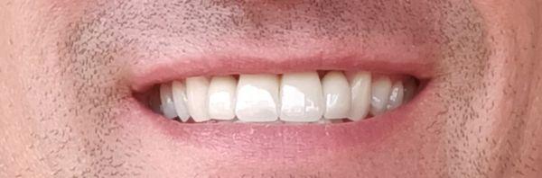 After DaVinici teeth whitening treatment.