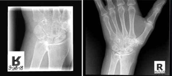 Pre/Post X-rays showing progress of regeneration